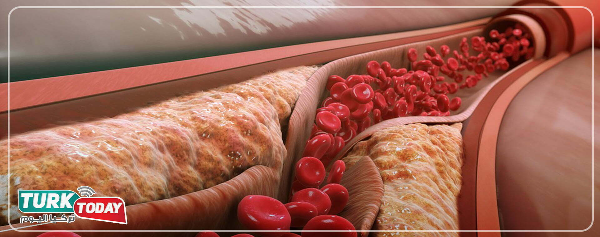 ما هي اعراض تصلب الشرايين؟